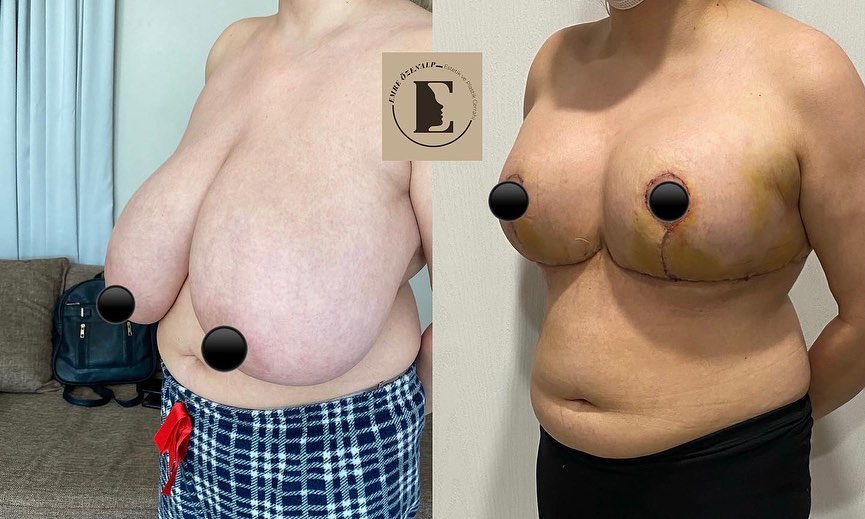 Porównanie sylwetki kobiety przed i po operacji zmniejszenia piersi w Turcji. Po lewej stronie ubranie leży niekorzystnie z powodu dużego biustu, a po prawej – układa się znacznie lepiej.