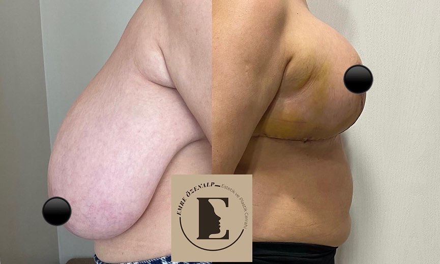 Kolaż przedstawiający piersi kobiety przed i po operacji zmniejszenia w Turcji. Po lewej stronie widoczne są większe piersi, a po prawej – mniejsze i bardziej proporcjonalne.